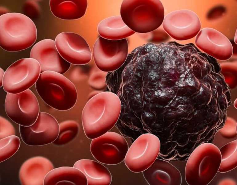 أنواع سرطان الدم عند الأطفال | مؤسسة وارث الدولية لعلاج اورام الاطفال