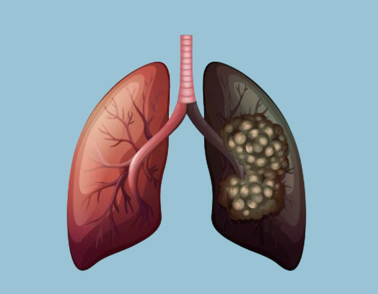 Lung-Cancer-Treatment